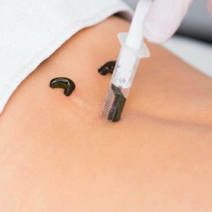 Leech therapy treatment in ghaziabad