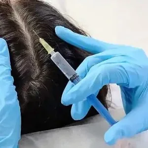 Hair transplant clinic in lucknow
