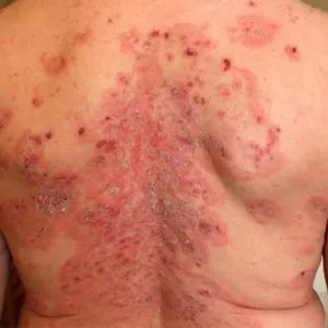 Find lasting relief from sarcoidosis with proven ayurvedic herbs
