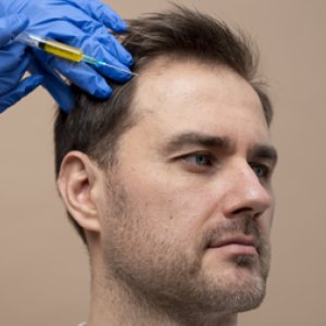Cost of hair transplant