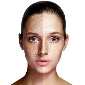 Dull skin treatment