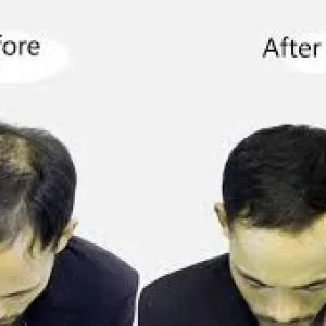Hair transplant surgery in nashik