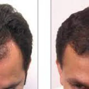 Hair transplant clinic in bangalore