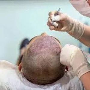 Best hair transplant in nashik | dr pranay thakur