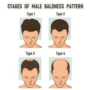 Hair loss treatment in chennai