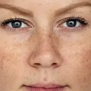 Pigmentation treatment in ludhiana