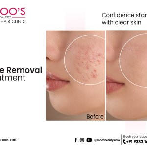 Advanced acne removal treatment at anoos