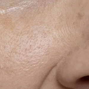 Open pores treatment in ludhiana