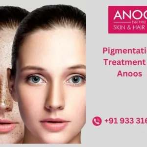 Advanced pigmentation treatment at anoos