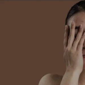 Acne scar treatment in south delhi- skination clinic