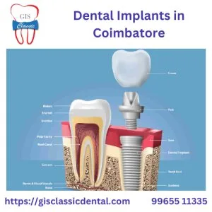Dental implants in coimbatore | implant dentistry coimbatore