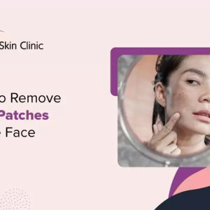 How to remove dark patches on the face - agelock skin clinic