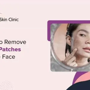 How to remove dark patches on the face - agelock skin clinic
