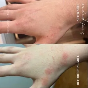 Skin healing balm for all skin types