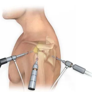 Total joint replacement surgery