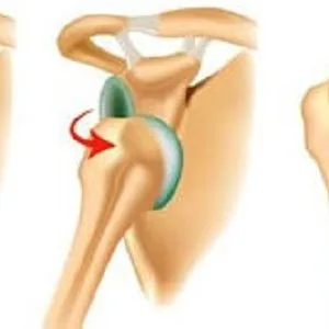 Shoulder dislocation treatment in delhi