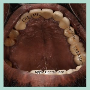 Dental implants in coimbatore
