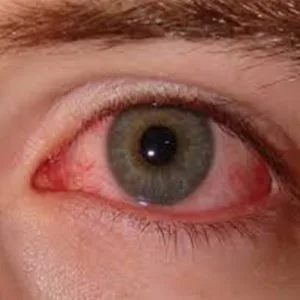 Best dry eye treatment