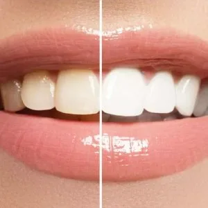Best teeth whitening abu dhabi