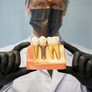 Dental crowns in al ain