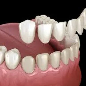 Veneers abu dhabi