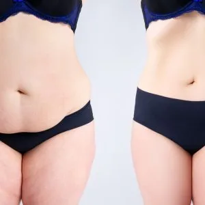 Best tummy tuck surgery in ahmedabad