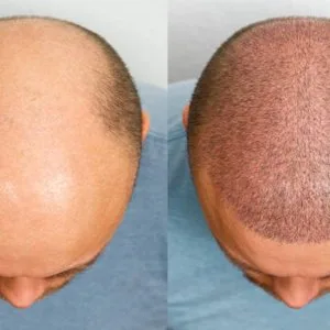 Best hair transplant surgery in ahmedabad