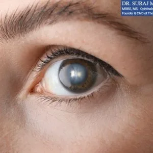 Cataract treatment in india