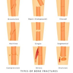 Types of fractures