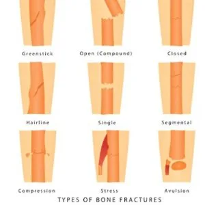 Types of fractures