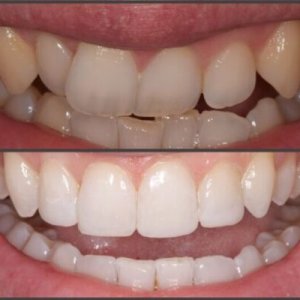 Why should you straighten teeth without braces?