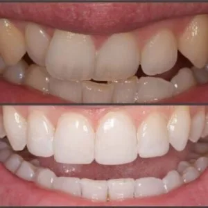 Why should you straighten teeth without braces?