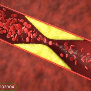 Peripheral artery disease in hyderabad