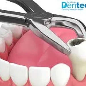 Tooth extraction abudhabi