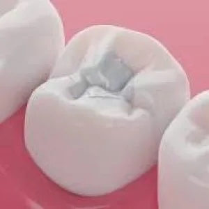 Cheap tooth filling in abudhabi