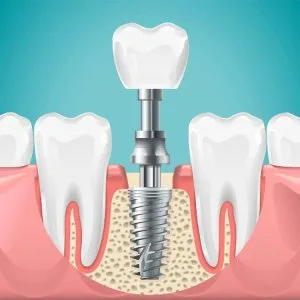 Dental implants cost per tooth – pricing & factors