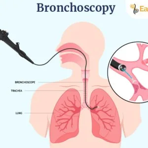 Bronchoscopy test centre in delhi ncr | easy book my lab