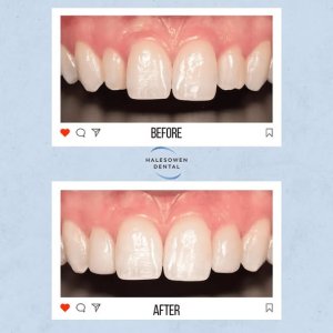 Searching for a better smile with invisalign birmingham?