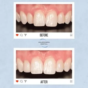 Searching for a better smile with invisalign birmingham?