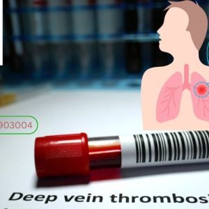 Best doctor for deep vein thrombosis in hyderabad | dr rahul ag