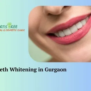 Teeth whitening treatment in gurgaon | artistree dental and cosm