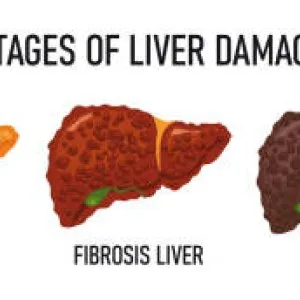 I help fatty liver disease with out cumbersome gym exercises