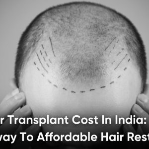 Hair transplant cost in india | qht clinic