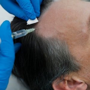 Best hair transplant clinic in india for advanced restoration