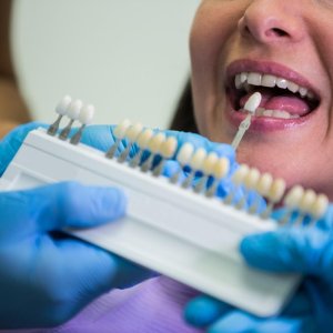 Porcelain veneers at best price – safe & aesthetic solution