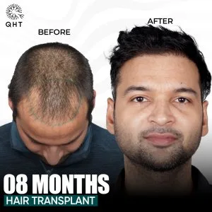 Qht hair transplant in noida