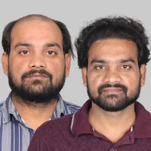 3000 grafts hair transplant cost in india