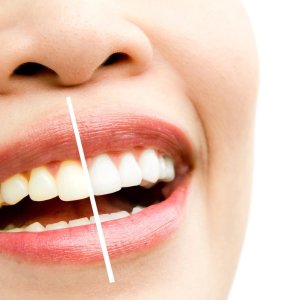 Teeth whitening at discounted rates – limited time in ahmedabad