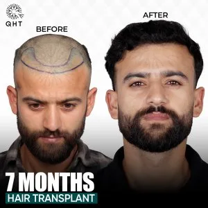 Cost of fue hair transplant in india: what to expect?