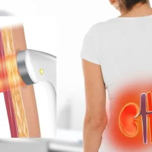 Painless kidney stone treatment without surgery - eswl by dr sk